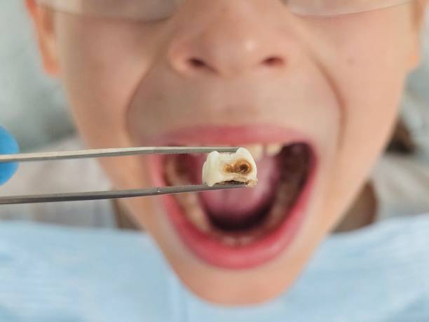 Best Emergency Root Canal Treatment in Worthgton, IN